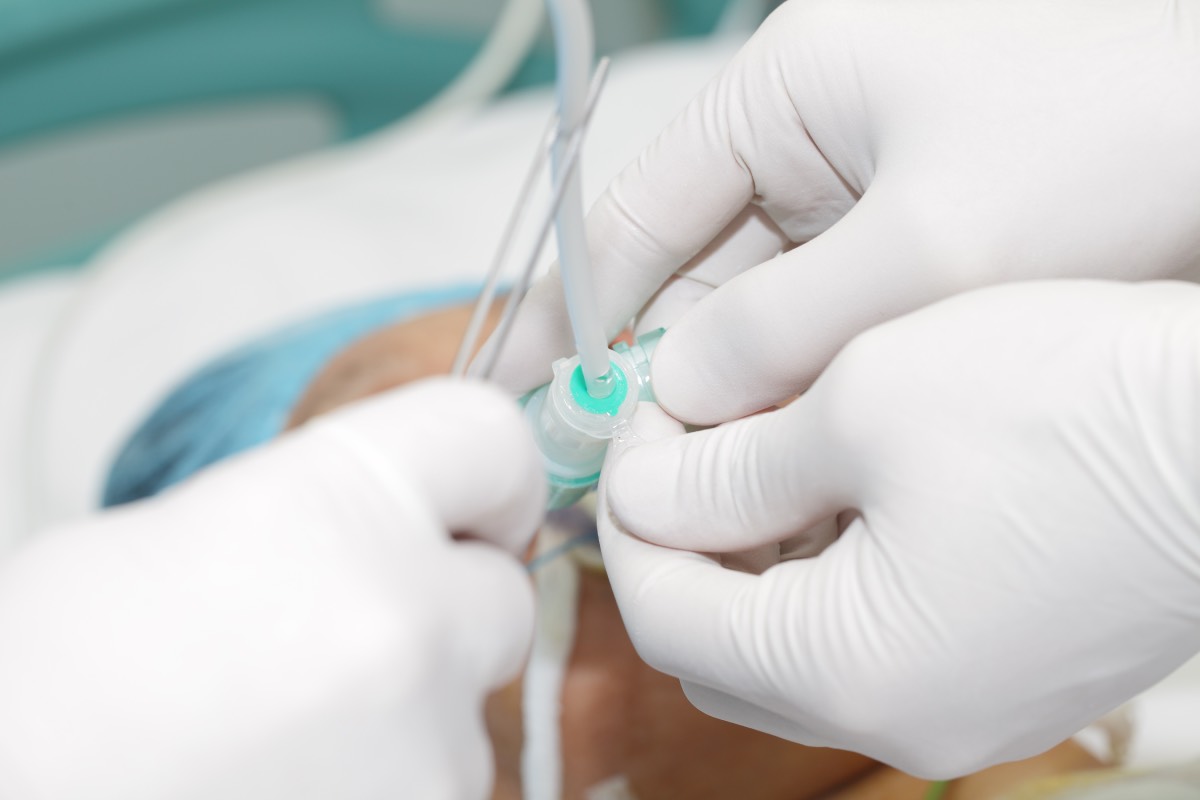 Tracheostomy in Non-Emergent Cases